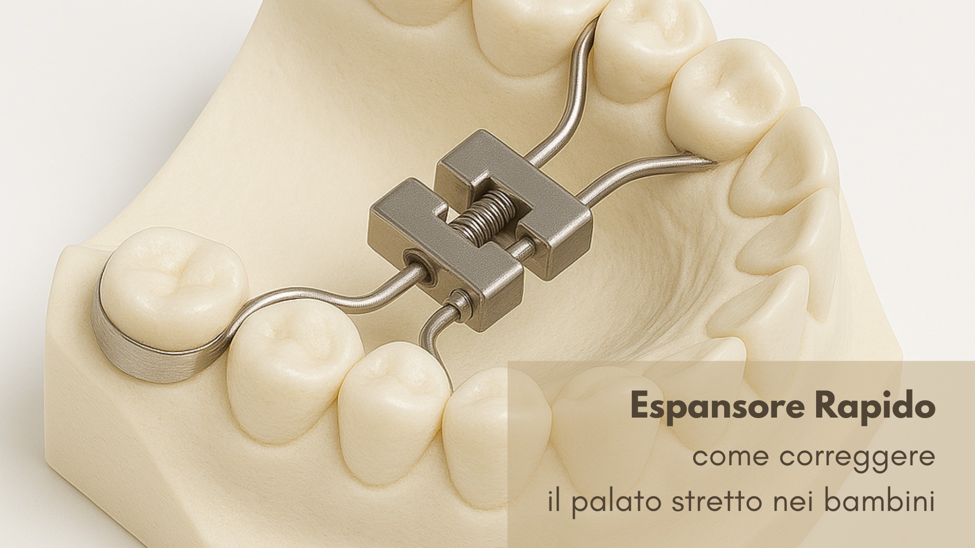 Modello anatomico con espansore rapido per il trattamento del palato stretto nei bambini