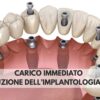 Render 3D di impianti dentali a carico immediato su arcata superiore