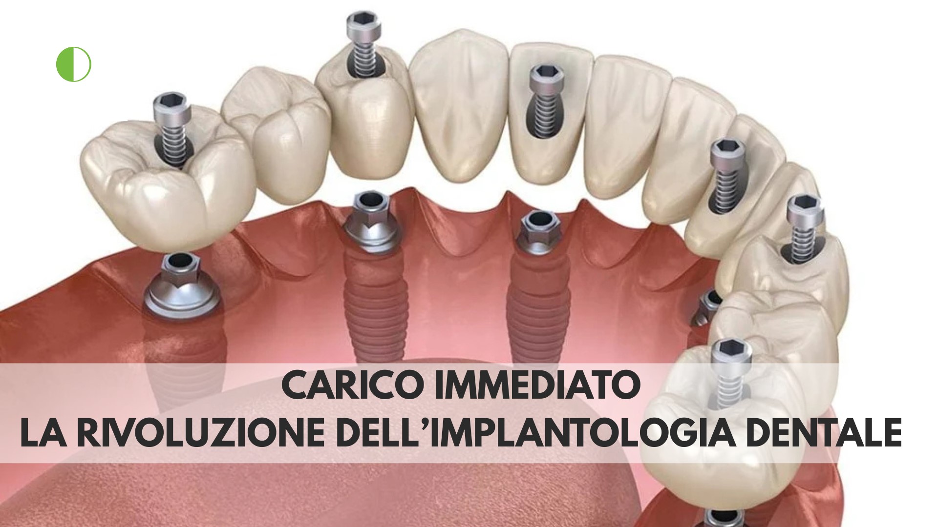 Render 3D di impianti dentali a carico immediato su arcata superiore