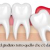 Rappresentazione grafica di dente del giudizio incluso e infiammato