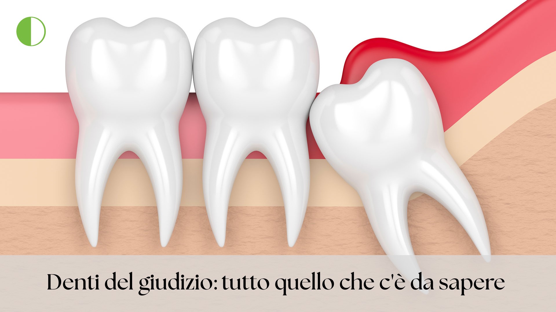 Rappresentazione grafica di dente del giudizio incluso e infiammato