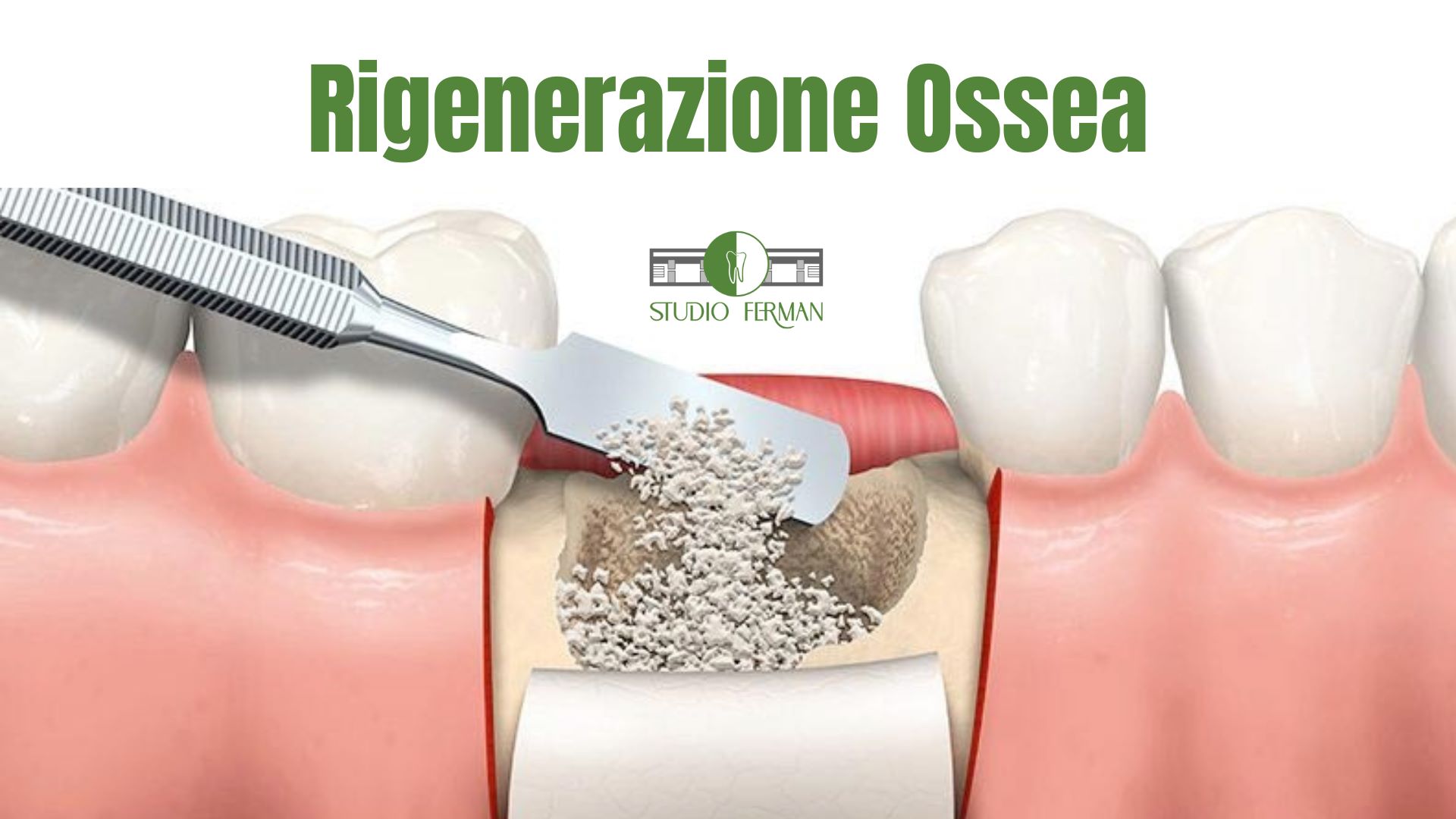 Illustrazione del processo di rigenerazione ossea dentale tramite inserimento di materiale biocompatibile per impianti.